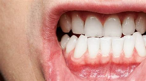 How to Get Food Out of Gums: A Journey Through the Labyrinth of Oral Hygiene and Beyond